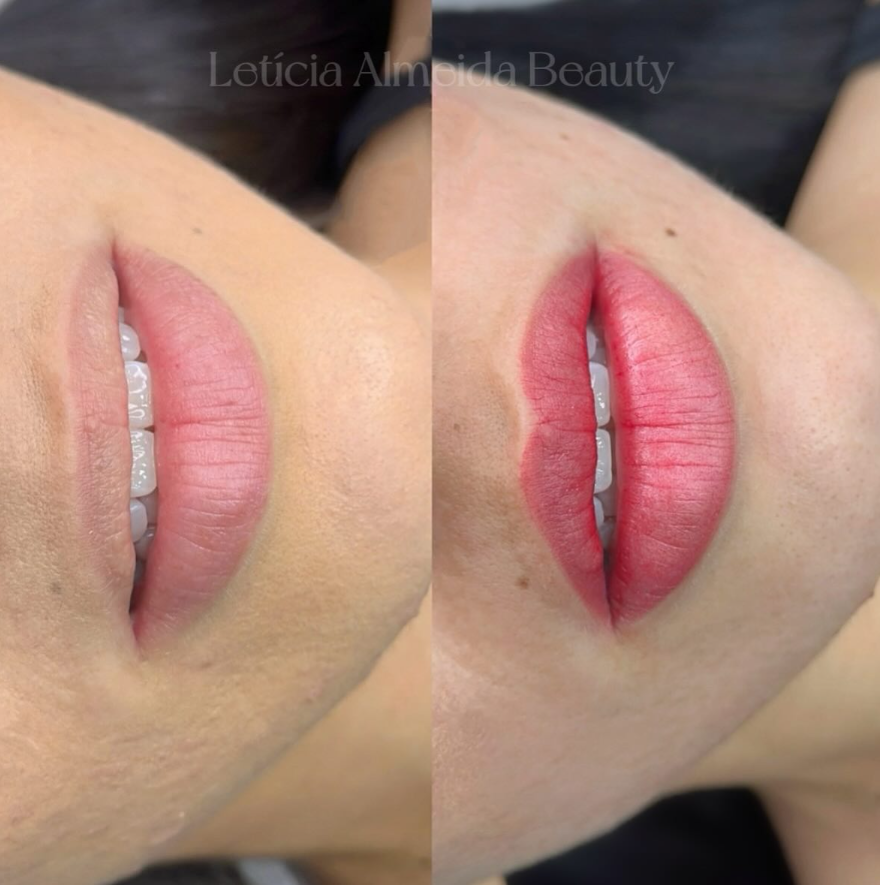 Antes e depois de procedimento de lábios realizado por Letícia Almeida
